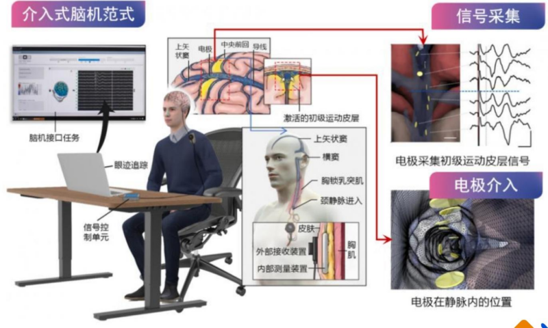 【四海读报】20260106：脑机接口专题报告-四海清单